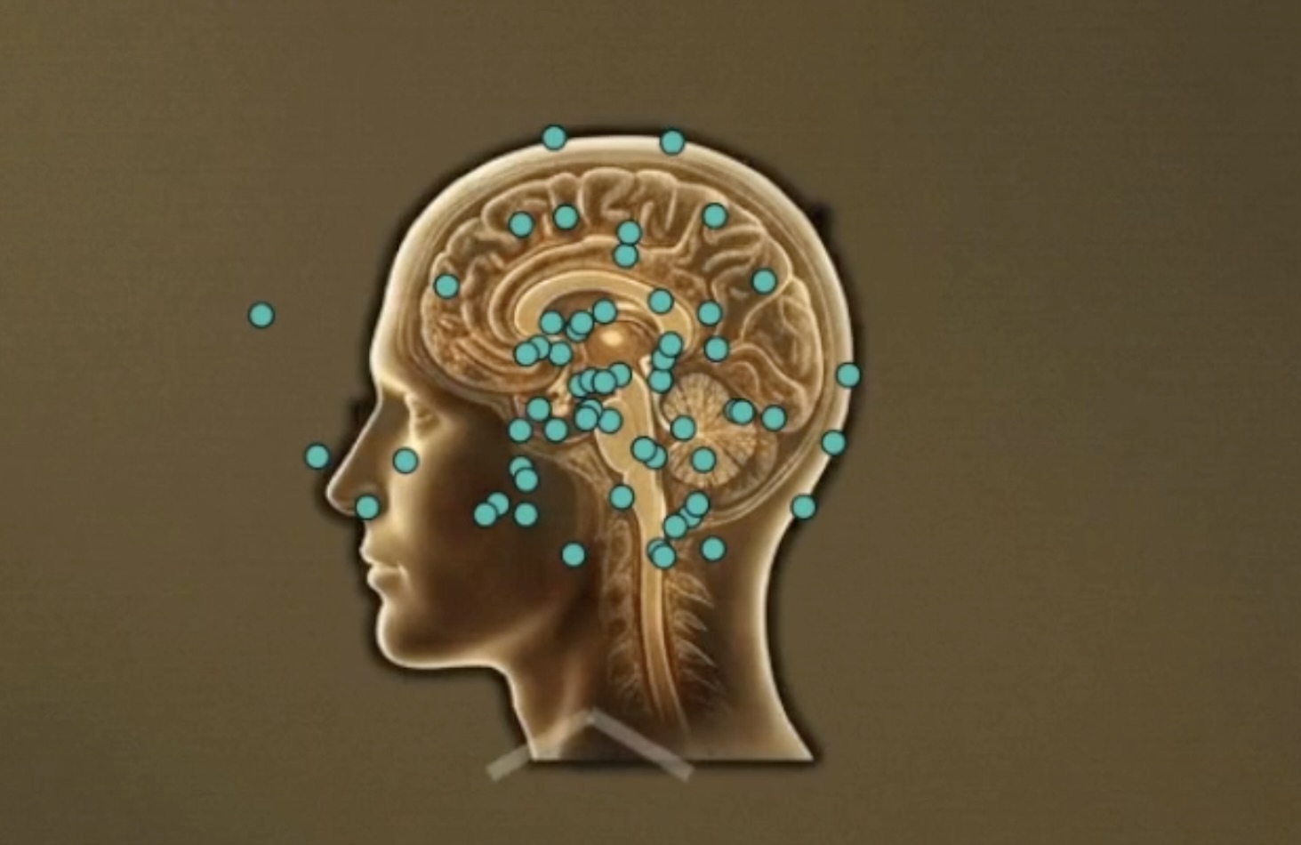 The Bopp Brain Screen